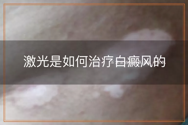 激光是如何治疗白癜风的