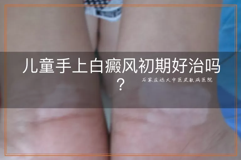 儿童手上白癜风初期好治吗？