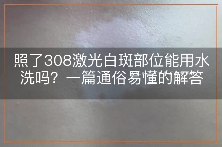 照了308激光白斑部位能用水洗吗？一篇通俗易懂的解答