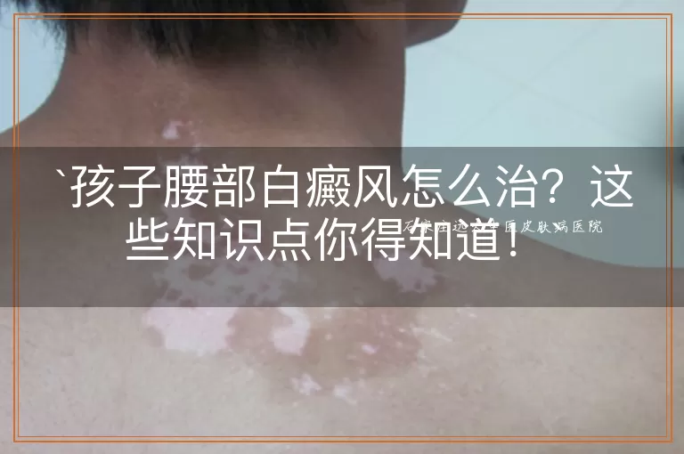 孩子腰部白癜风怎么治?这些知识点你得知道!