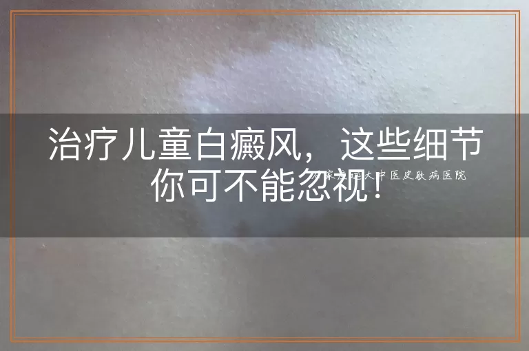 治疗儿童白癜风，这些细节你可不能忽视！