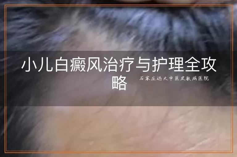 小儿白癜风治疗与护理全攻略