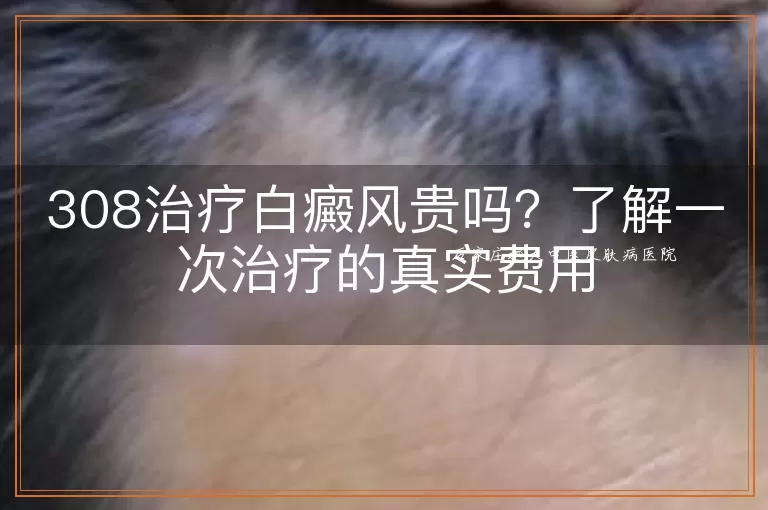 308治疗白癜风贵吗？了解一次治疗的真实费用