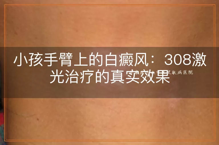 小孩手臂上的白癜风：308激光治疗的真实效果