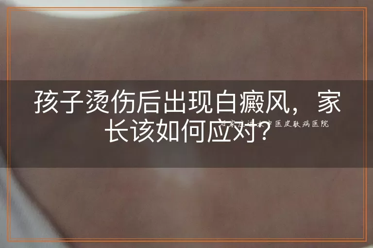 孩子烫伤后出现白癜风，家长该如何应对？