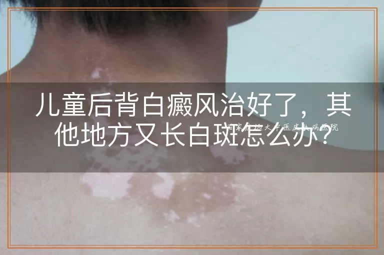 儿童后背白癜风治好了，其他地方又长白斑怎么办？