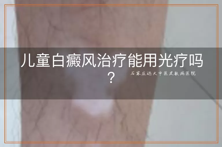 儿童白癜风治疗能用光疗吗？