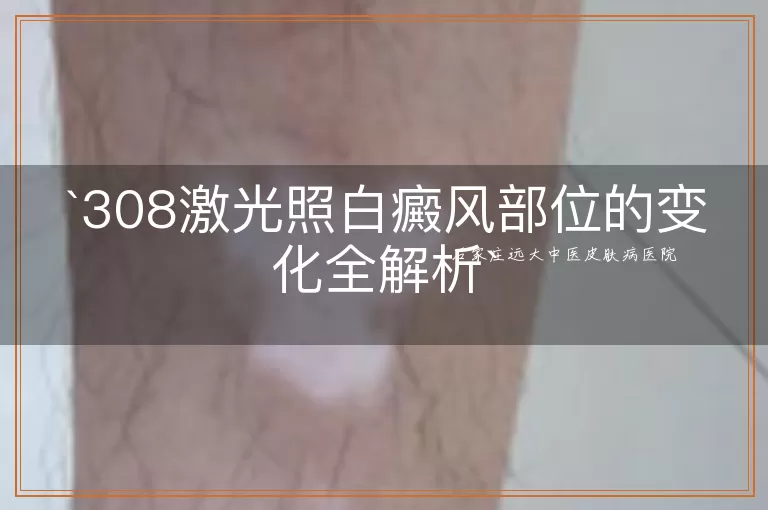308激光照白癜风部位的变化全解析