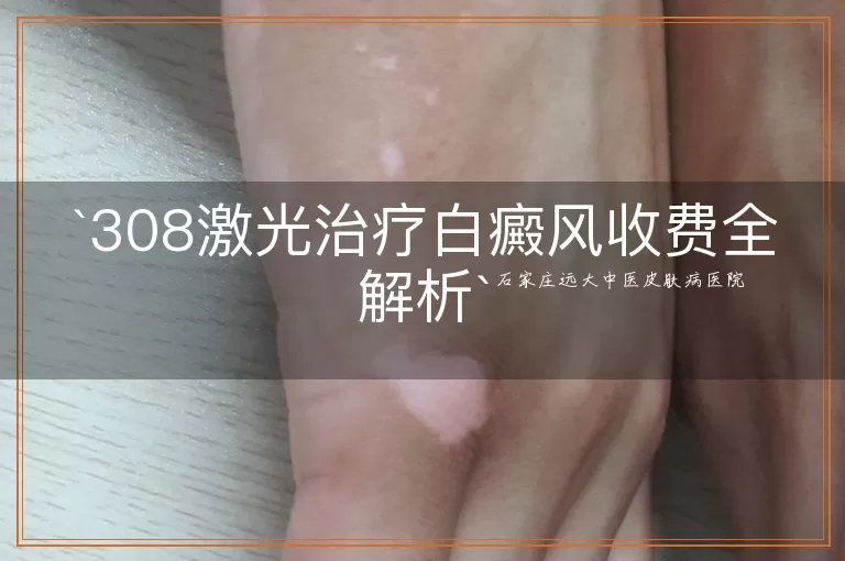 308激光治疗白癜风收费全解析