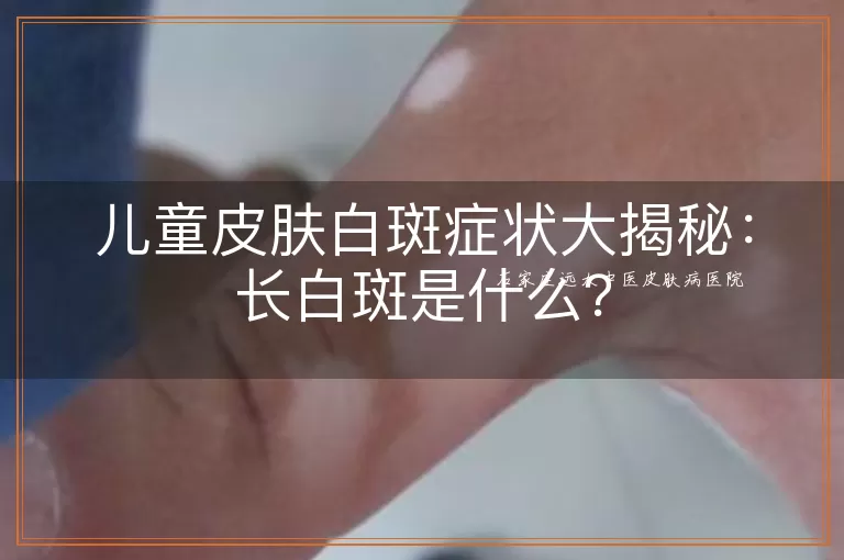 儿童皮肤白斑症状大揭秘:长白斑是什么?