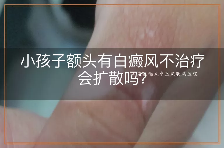 小孩子额头有白癜风不治疗会扩散吗？