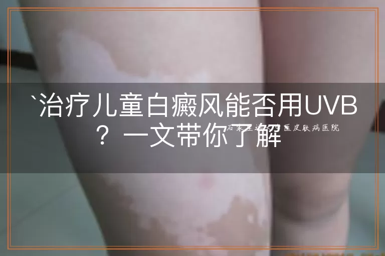 治疗儿童白癜风能否用UVB？一文带你了解