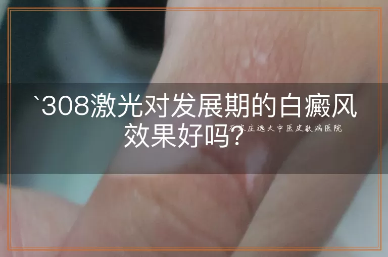 308激光对发展期的白癜风效果好吗？