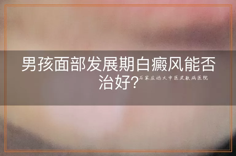 男孩面部发展期白癜风能否治好？