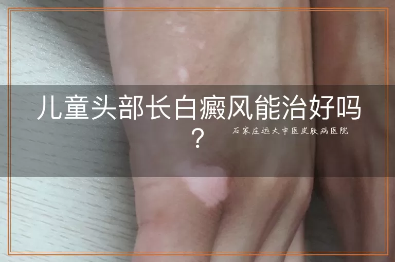 儿童头部长白癜风能治好吗?