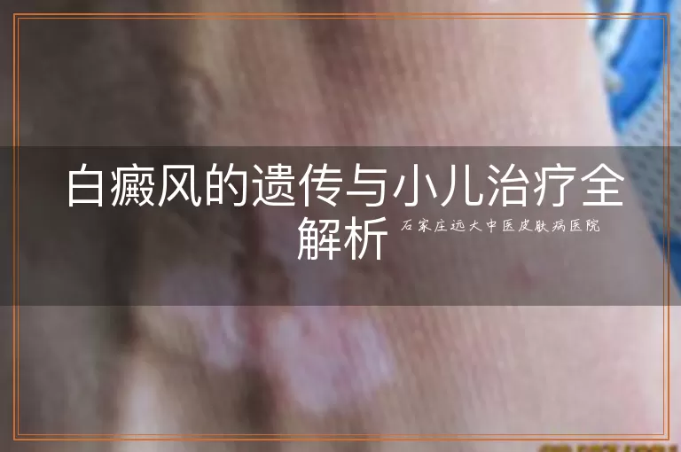 白癜风的遗传与小儿治疗全解析