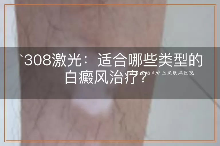 308激光：适合哪些类型的白癜风治疗？