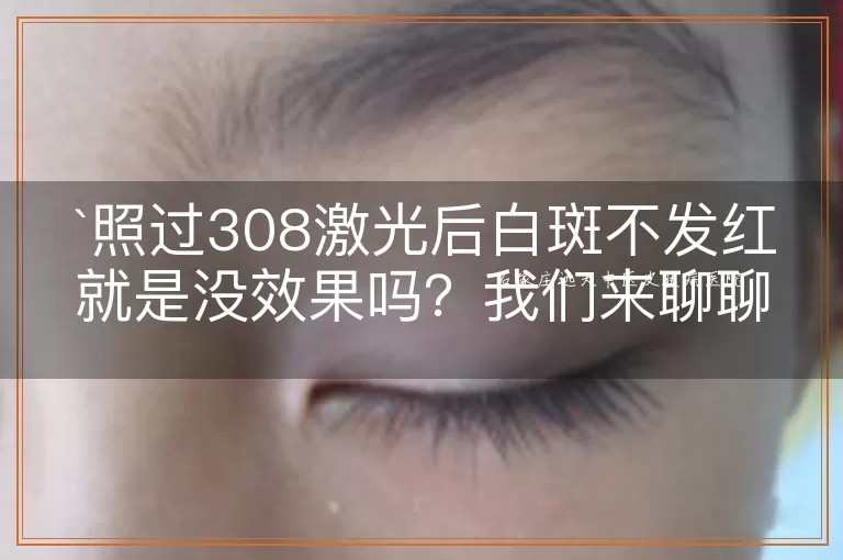 照过308激光后白斑不发红就是没效果吗？我们来聊聊这事儿！