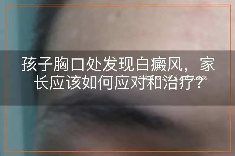 孩子胸口处发现白癜风，家长应该如何应对和治疗？