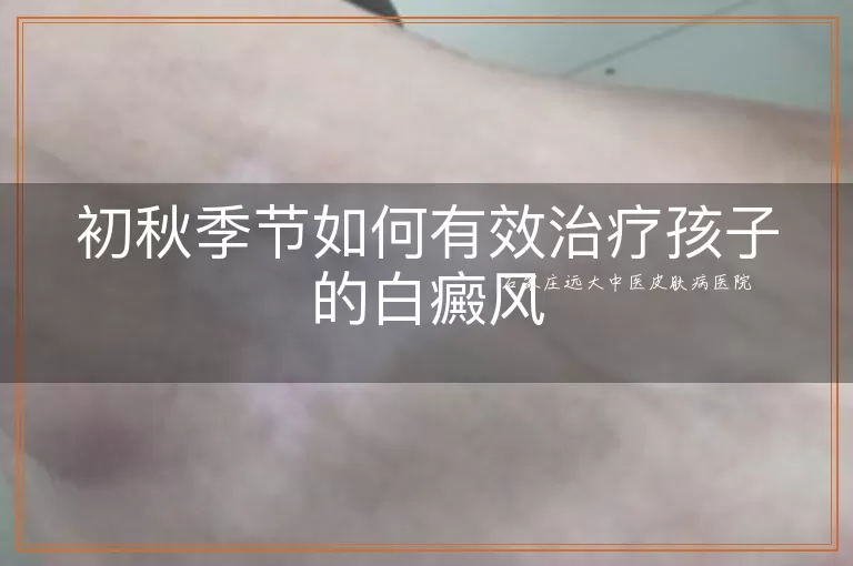 初秋季节如何有效治疗孩子的白癜风
