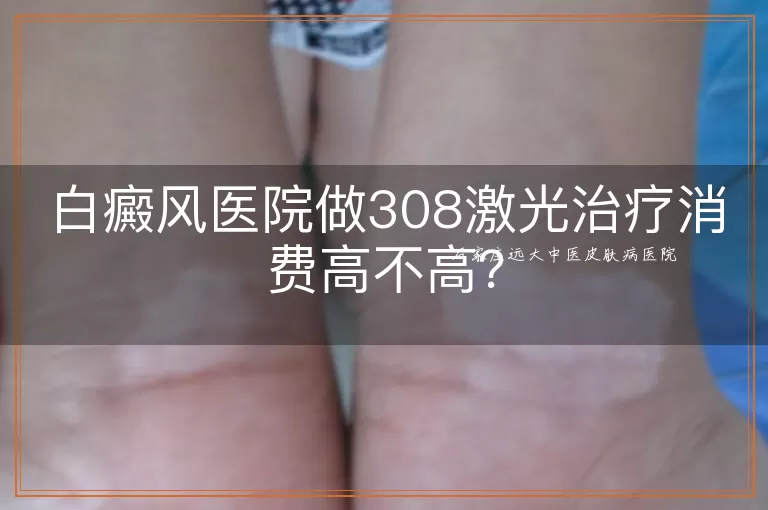 白癜风医院做308激光治疗消费高不高？