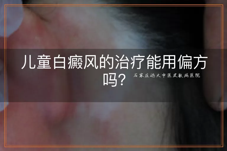 儿童白癜风的治疗能用偏方吗？