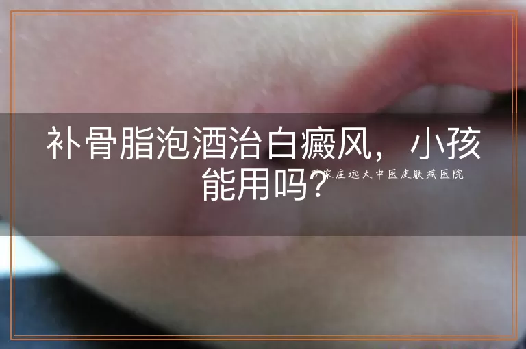 补骨脂泡酒治白癜风，小孩能用吗？