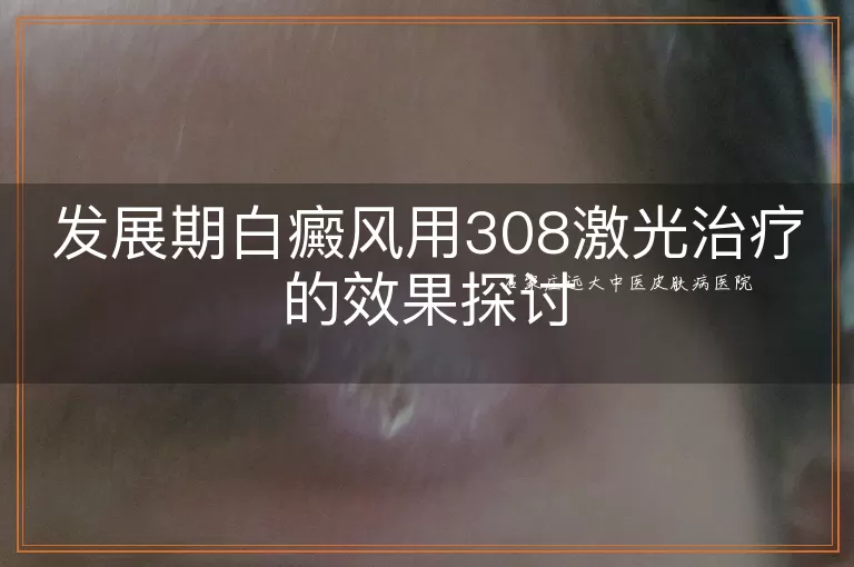 发展期白癜风用308激光治疗的效果探讨