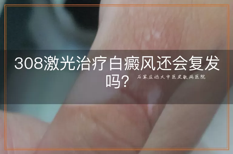 308激光治疗白癜风还会复发吗？