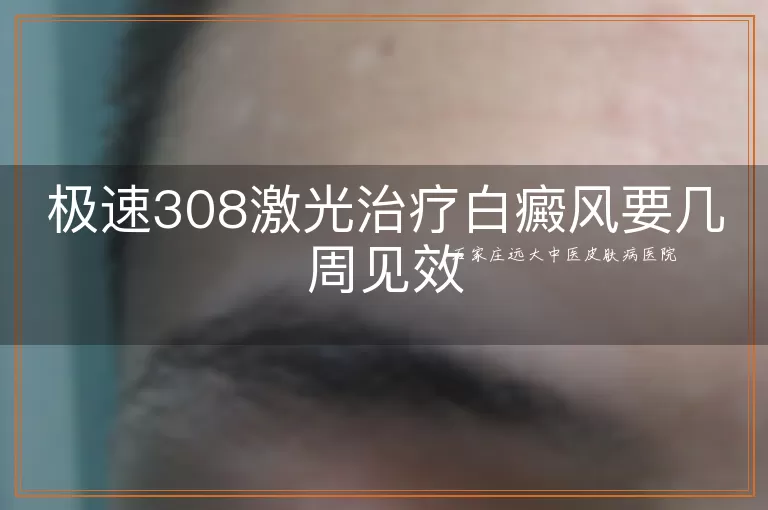 极速308激光治疗白癜风要几周见效