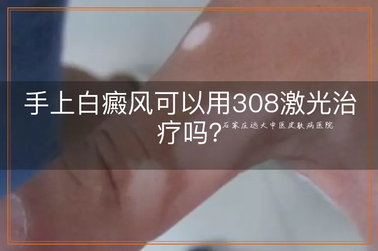手上白癜风可以用308激光治疗吗？