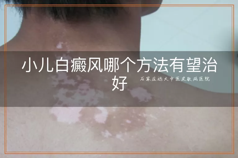 小儿白癜风哪个方法有望治好