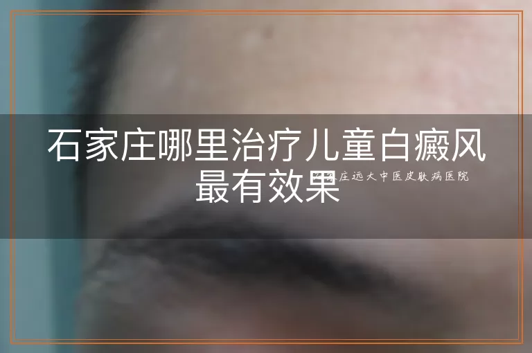 石家庄哪里治疗儿童白癜风最有效果