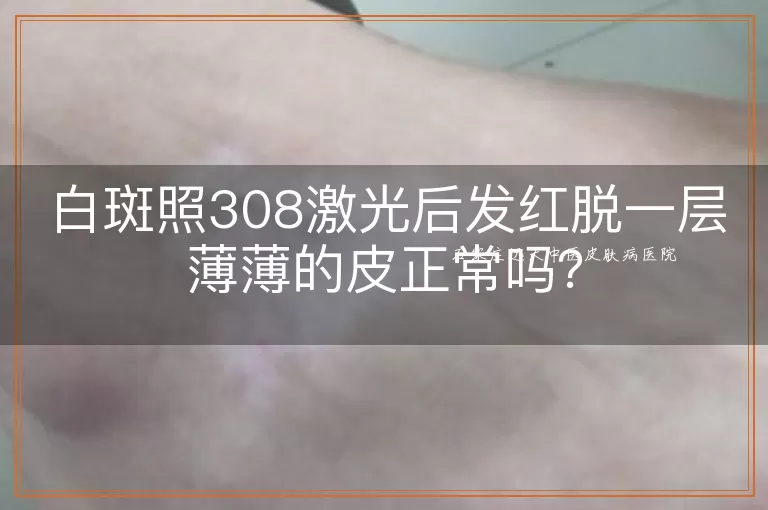 白斑照308激光后发红脱一层薄薄的皮正常吗?