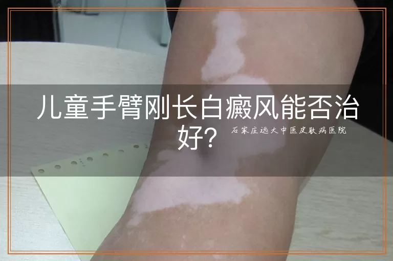 儿童手臂刚长白癜风能否治好？