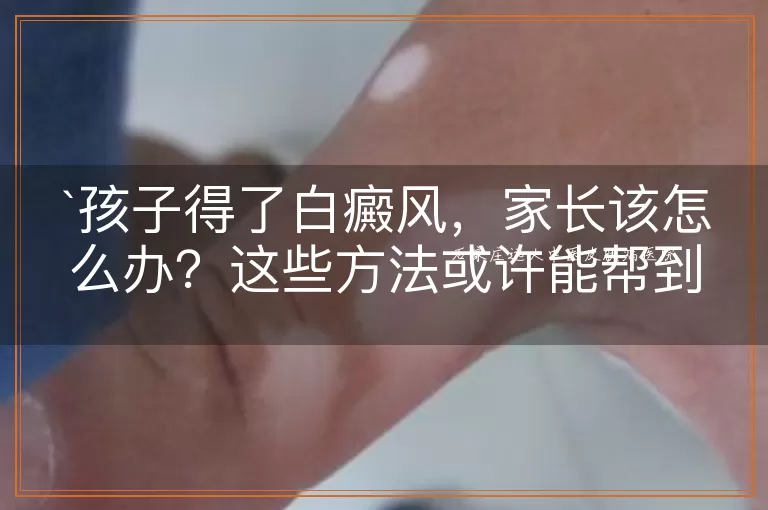 孩子得了白癜风，家长该怎么办？这些方法或许能帮到你！