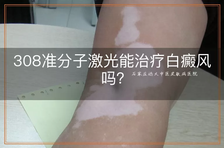 308准分子激光能治疗白癜风吗？