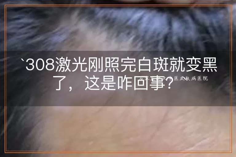 308激光刚照完白斑就变黑了,这是咋回事?