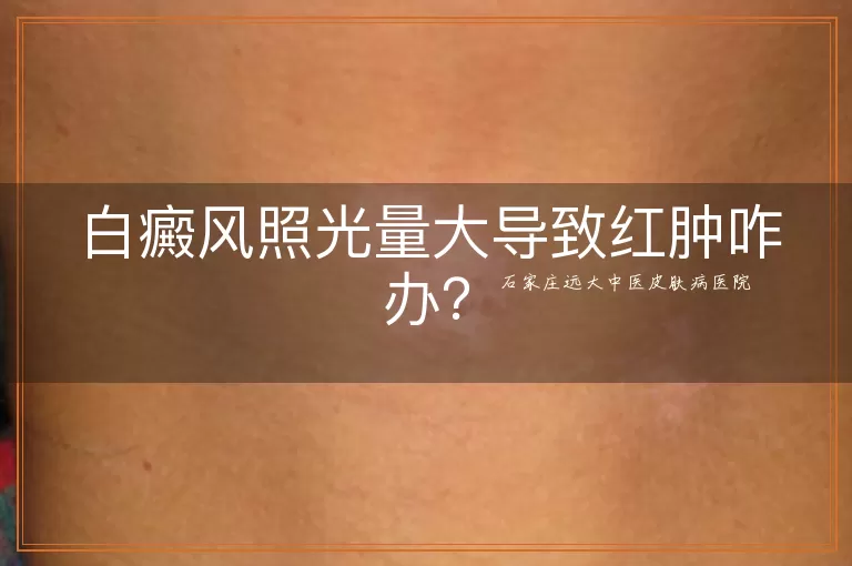 白癜风照光量大导致红肿咋办？