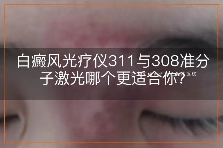 白癜风光疗仪311与308准分子激光哪个更适合你？