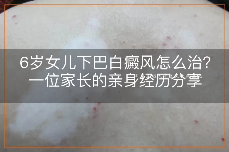 6岁女儿下巴白癜风怎么治？一位家长的亲身经历分享