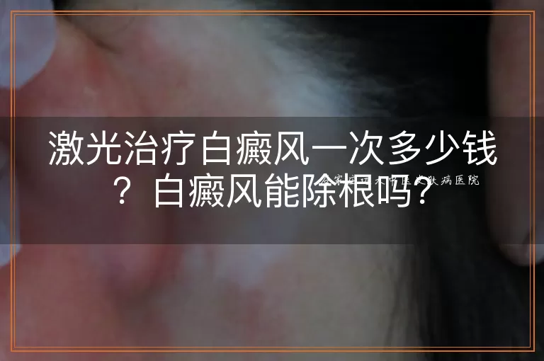 激光治疗白癜风一次多少钱?白癜风能除根吗?