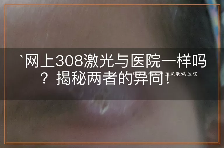 网上308激光与医院一样吗？揭秘两者的异同！