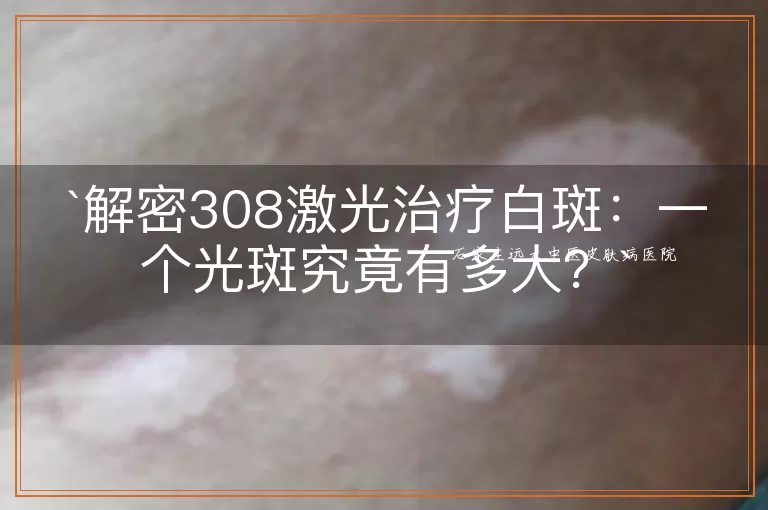解密308激光治疗白斑：一个光斑究竟有多大？