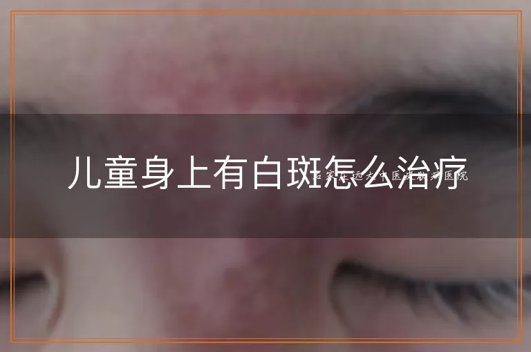 儿童身上有白斑怎么治疗