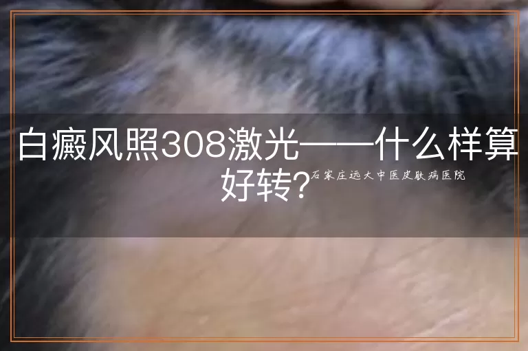 白癜风照308激光——什么样算好转？