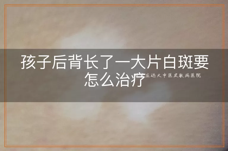孩子后背长了一大片白斑要怎么治疗