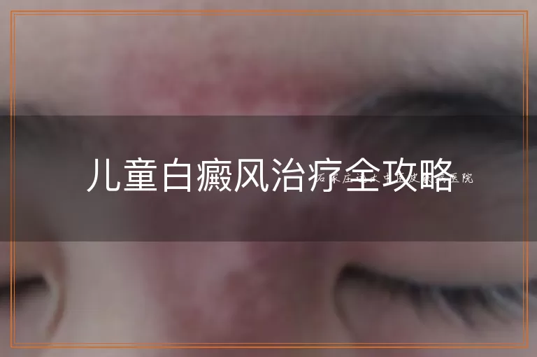 儿童白癜风治疗全攻略