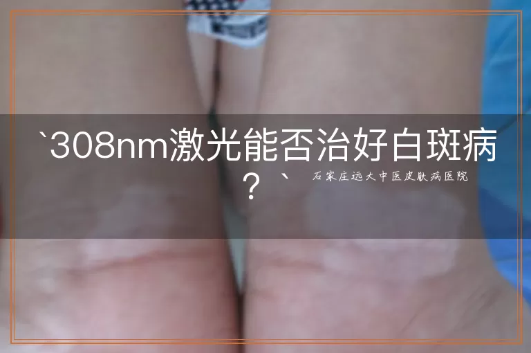 308nm激光能否治好白斑病？
