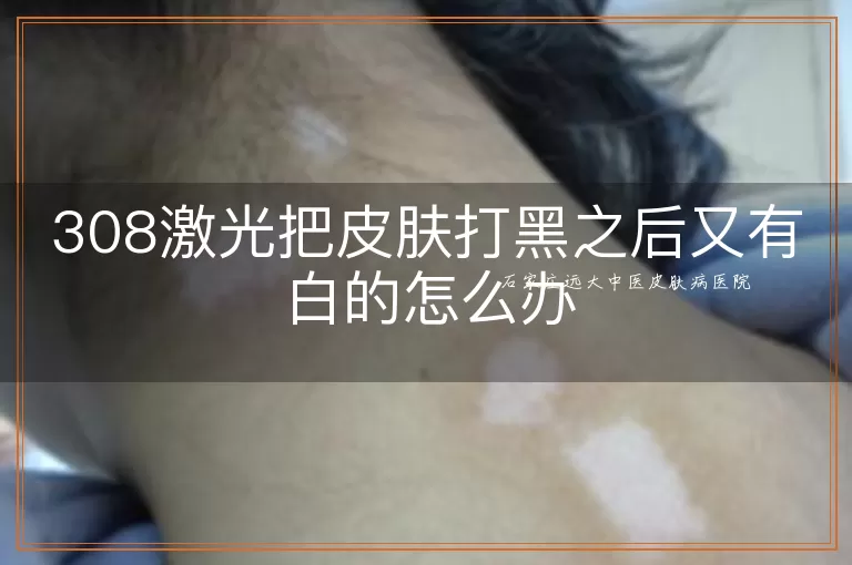 308激光把皮肤打黑之后又有白的怎么办